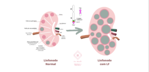 Linfoma Folicular (LF): um tipo indolente de linfoma não-Hodgkin de células B.